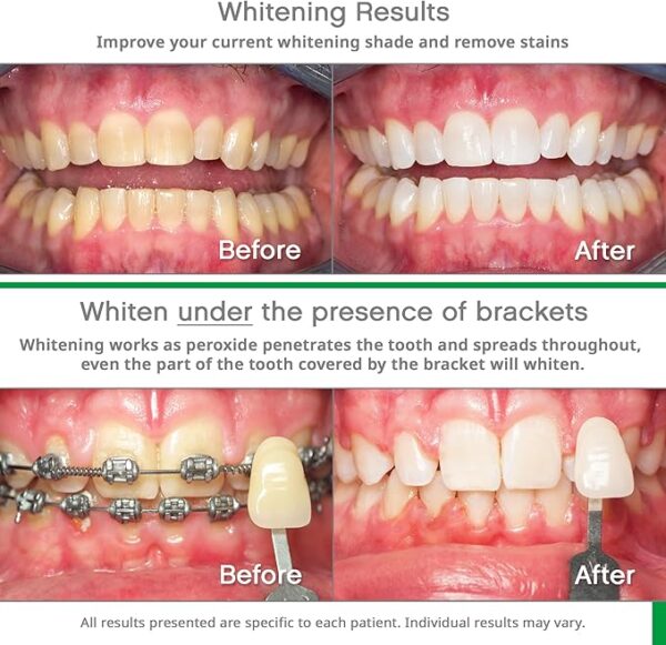 Opalescence Go 10% - Prefilled Teeth Whitening Trays Kit (10 Treatments) - 10% Hydrogen Peroxide - Mint Made by Ultradent Products. Go Teeth Whitening Kit -Mint- GO10-5193-1 - Image 2